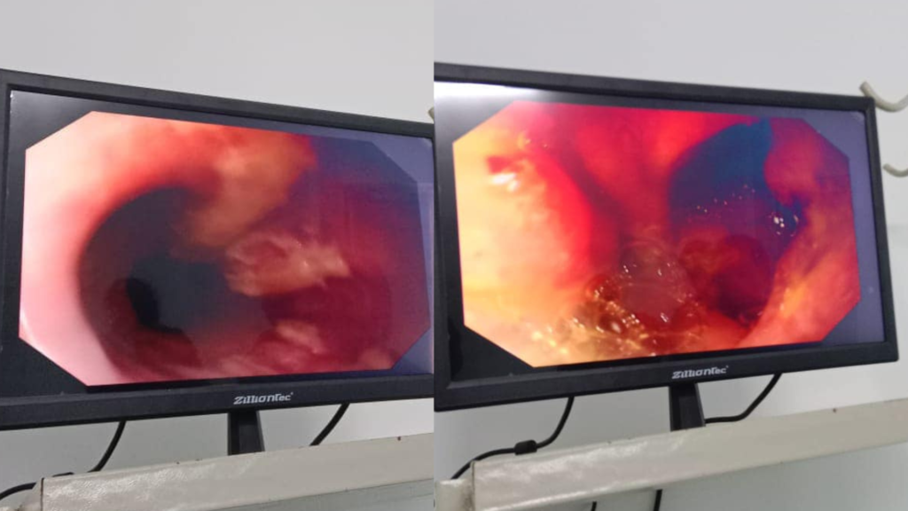 BHC Hospital Confirms Rare Duodenal Carcinoma Case